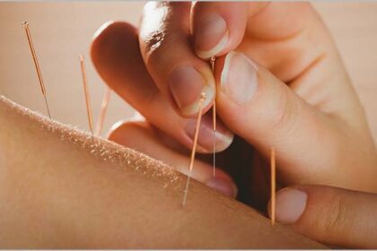 recall-healing-with-acupuncture-in-edmonton:-a-holistic-approach-to-wellness